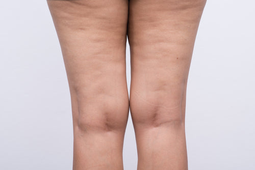 3 Easy Ways to Reduce Cellulite At Home: